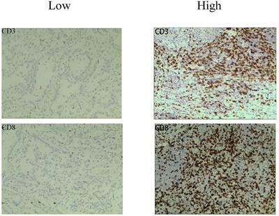 Prediction of CD3 T cells and CD8 T cells expression levels in non-small cell lung cancer based on radiomic features of CT images